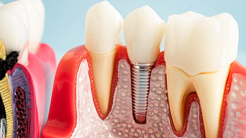 Dental Implant Treatment